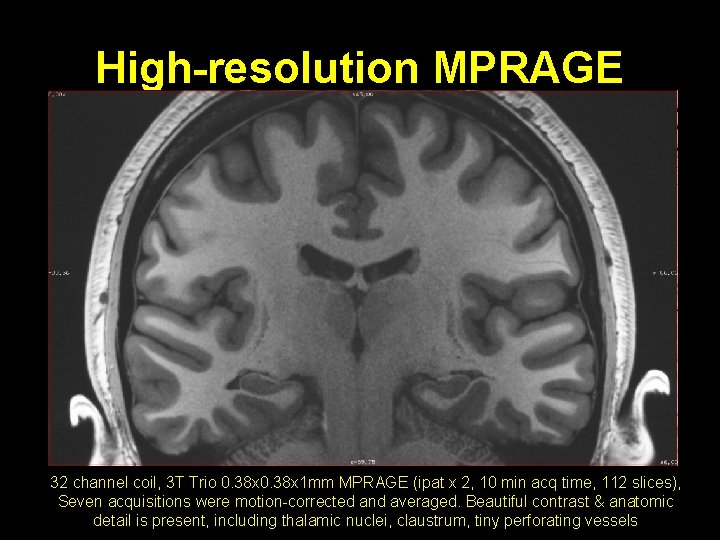 High-resolution MPRAGE 32 channel coil, 3 T Trio 0. 38 x 1 mm MPRAGE