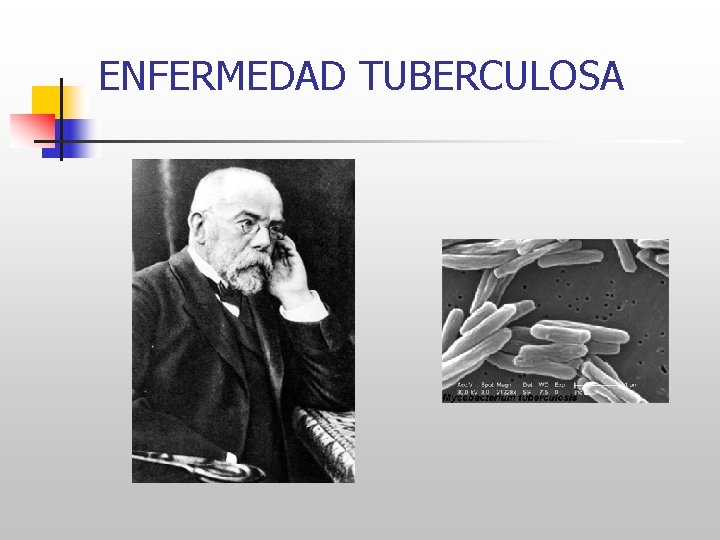 ENFERMEDAD TUBERCULOSA 