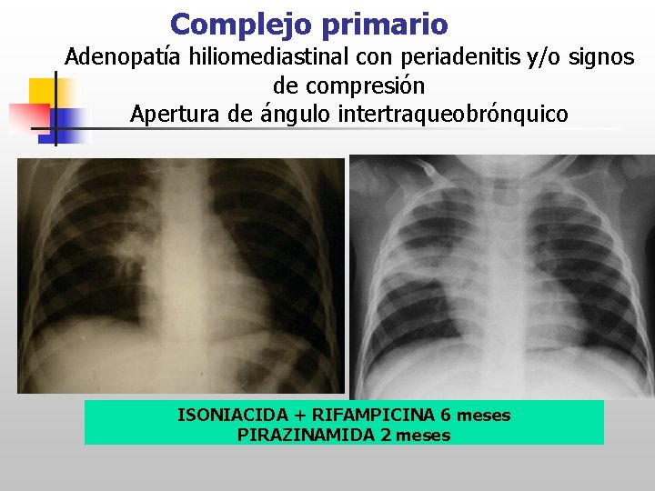 Complejo primario Adenopatía hiliomediastinal con periadenitis y/o signos de compresión Apertura de ángulo intertraqueobrónquico