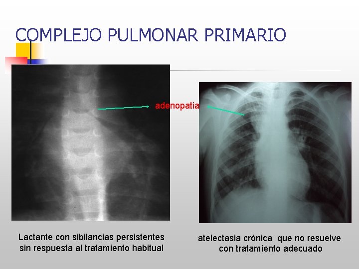 COMPLEJO PULMONAR PRIMARIO adenopatia Lactante con sibilancias persistentes sin respuesta al tratamiento habitual atelectasia