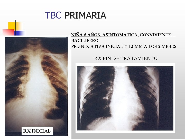 TBC PRIMARIA NIÑA 6 AÑOS, ASINTOMATICA, CONVIVIENTE BACILIFERO PPD NEGATIVA INICIAL Y 12 MM