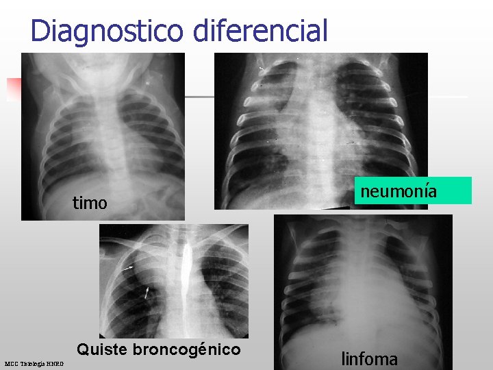 Diagnostico diferencial timo Quiste broncogénico MCC Tisiología HNRG neumonía linfoma 