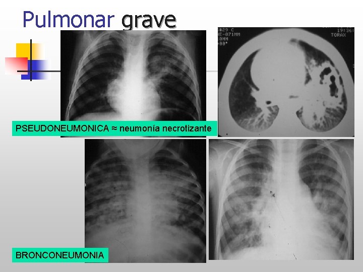 Pulmonar grave PSEUDONEUMONICA ≈ neumonía necrotizante MCCTHNRG BRONCONEUMONIA 