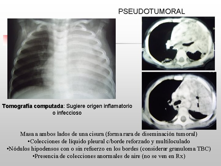PSEUDOTUMORAL Pulmonar grave MCCTHNRG Tomografía computada: computada Sugiere origen inflamatorio o infeccioso Masa a