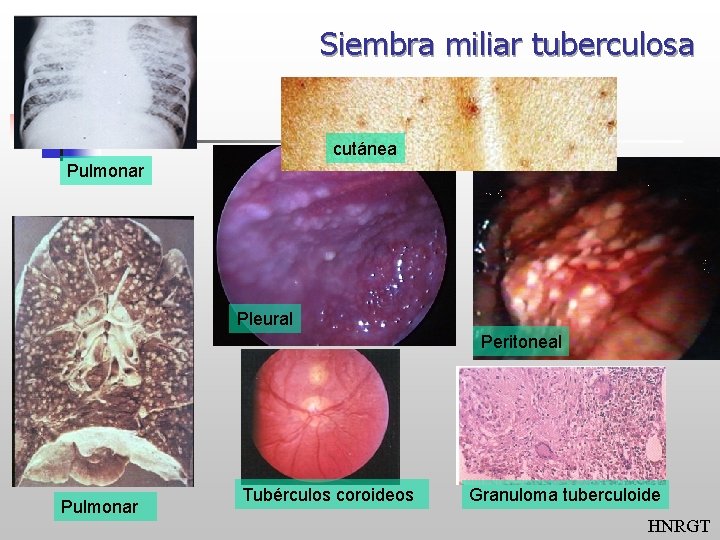 Siembra miliar tuberculosa cutánea Pulmonar Pleural Peritoneal Pulmonar Tubérculos coroideos Granuloma tuberculoide HNRGT 