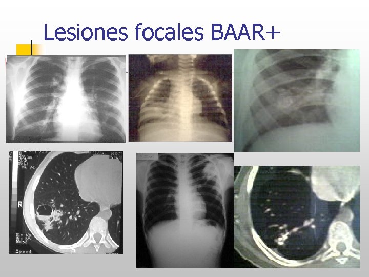 Lesiones focales BAAR+ 