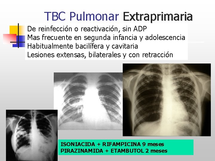 TBC Pulmonar Extraprimaria De reinfección o reactivación, sin ADP Mas frecuente en segunda infancia