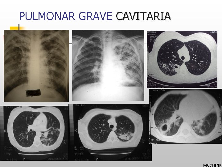 PULMONAR GRAVE CAVITARIA MCCTHNRG 