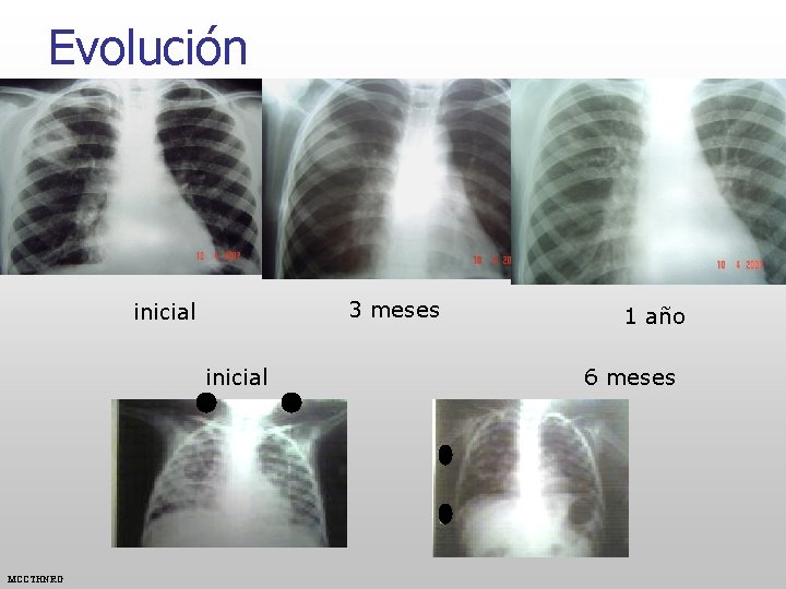 Evolución 3 meses inicial MCCTHNRG 1 año 6 meses 