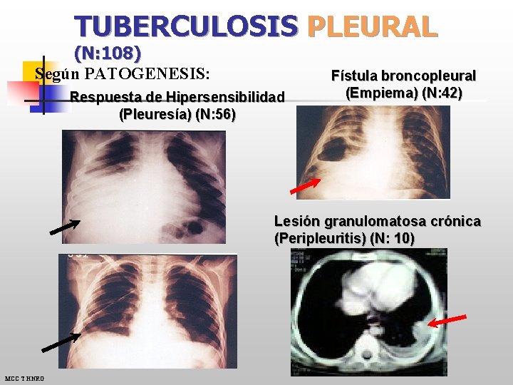 TUBERCULOSIS PLEURAL (N: 108) Según PATOGENESIS: Respuesta de Hipersensibilidad (Pleuresía) (N: 56) Fístula broncopleural