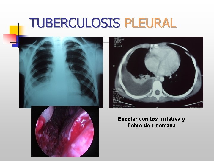 TUBERCULOSIS PLEURAL Escolar con tos irritativa y fiebre de 1 semana MCC T HNRG