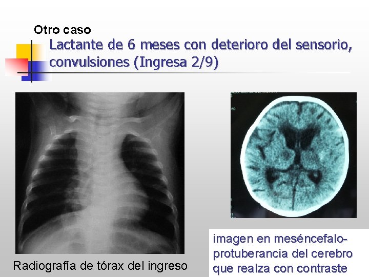 Otro caso Lactante de 6 meses con deterioro del sensorio, convulsiones (Ingresa 2/9) Radiografía
