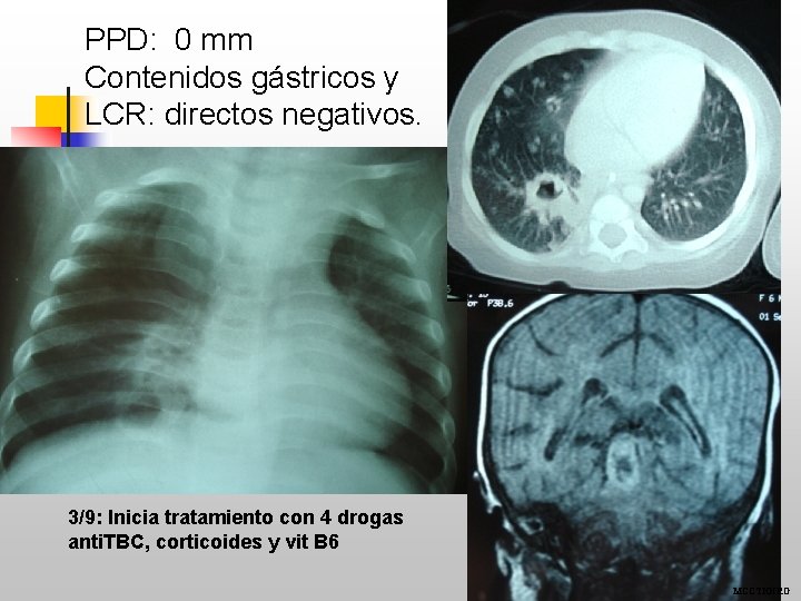 PPD: 0 mm Contenidos gástricos y LCR: directos negativos. 3/9: Inicia tratamiento con 4