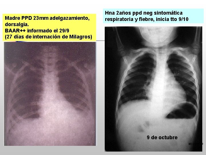 Madre PPD 23 mm adelgazamiento, dorsalgia. BAAR++ informado el 29/9 (27 días de internación