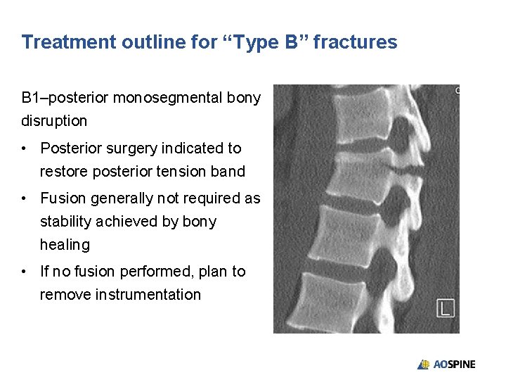 Treatment outline for “Type B” fractures B 1–posterior monosegmental bony disruption • Posterior surgery