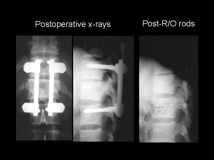 Postoperative x-rays Post-R/O rods 