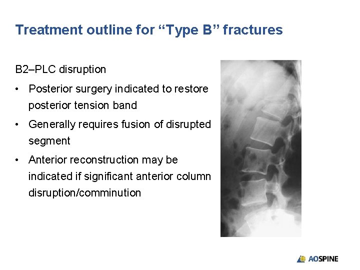 Treatment outline for “Type B” fractures B 2–PLC disruption • Posterior surgery indicated to
