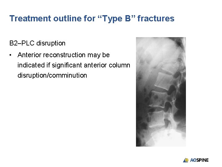 Treatment outline for “Type B” fractures B 2–PLC disruption • Anterior reconstruction may be