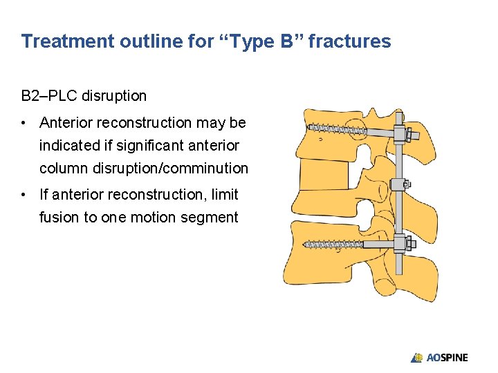 Treatment outline for “Type B” fractures B 2–PLC disruption • Anterior reconstruction may be