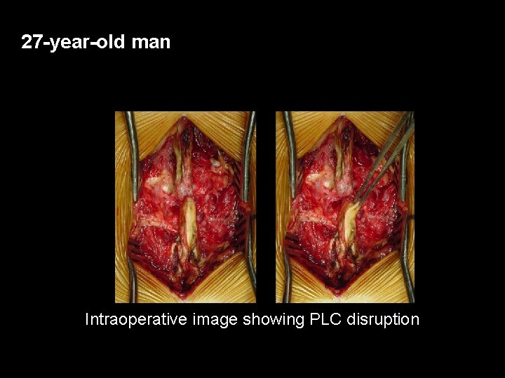 27 -year-old man Intraoperative image showing PLC disruption 