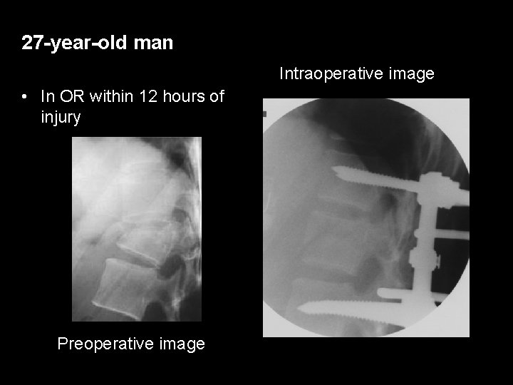 27 -year-old man Intraoperative image • In OR within 12 hours of injury Preoperative