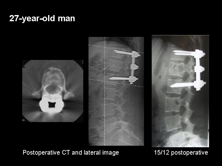 27 -year-old man Postoperative CT and lateral image 15/12 postoperative 