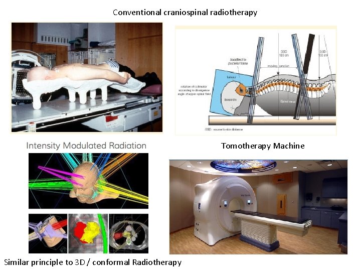 Conventional craniospinal radiotherapy Tomotherapy Machine Similar principle to 3 D / conformal Radiotherapy 