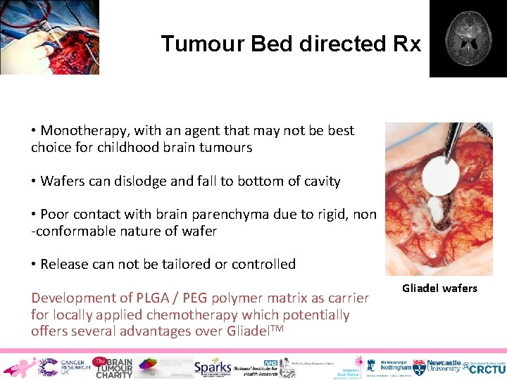 Tumour Bed directed Rx However : • Monotherapy, with an agent that may not