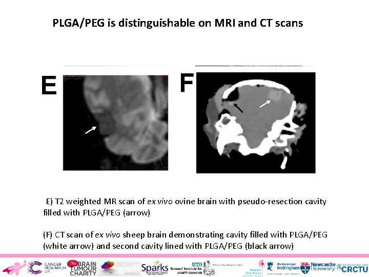 PLGA/PEG is distinguishable on MRI and CT scans (E) T 2 weighted MR scan
