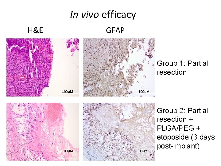 In vivo efficacy H&E GFAP Group 1: Partial resection 100µM Group 2: Partial resection