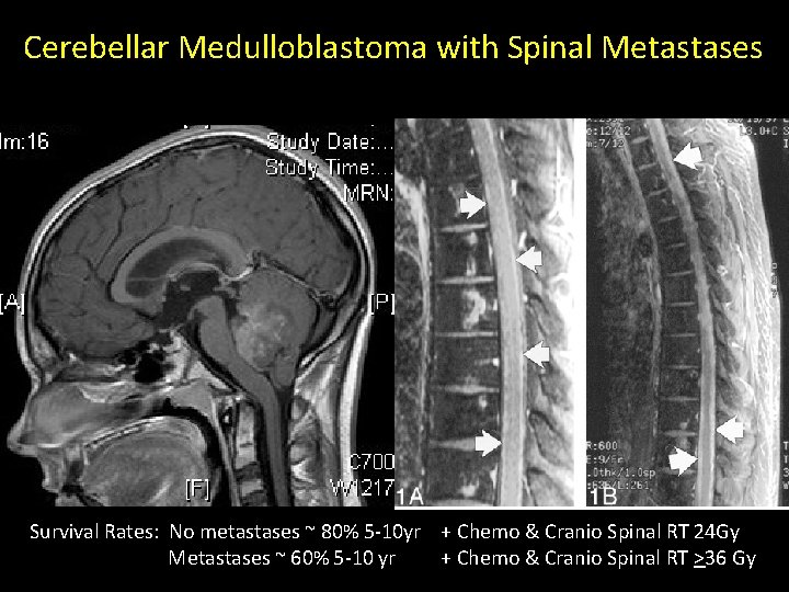 Cerebellar Medulloblastoma with Spinal Metastases Survival Rates: No metastases ~ 80% 5 -10 yr