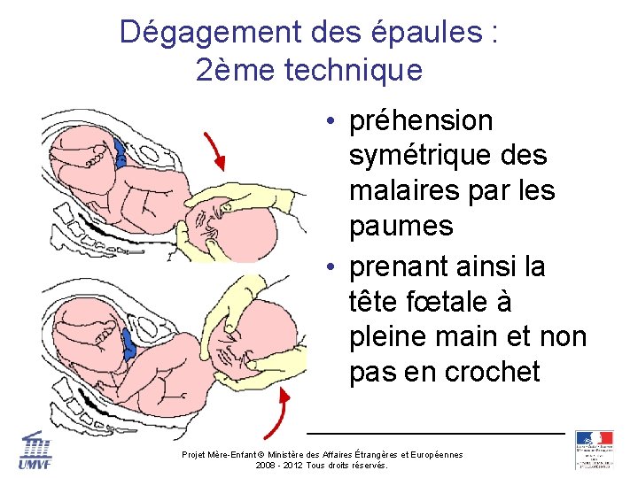 Dégagement des épaules : 2ème technique • préhension symétrique des malaires par les paumes