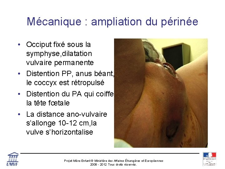 Mécanique : ampliation du périnée • Occiput fixé sous la symphyse, dilatation vulvaire permanente