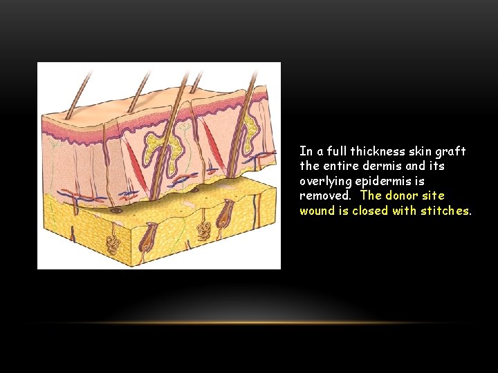 In a full thickness skin graft the entire dermis and its overlying epidermis is