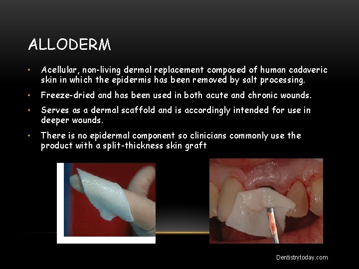 ALLODERM • Acellular, non-living dermal replacement composed of human cadaveric skin in which the