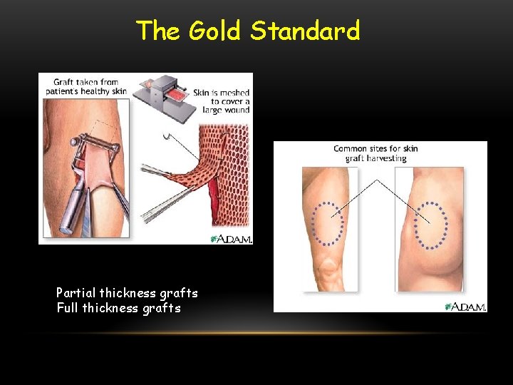 The Gold Standard Partial thickness grafts Full thickness grafts 
