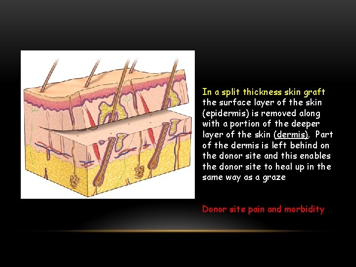 In a split thickness skin graft the surface layer of the skin (epidermis) is