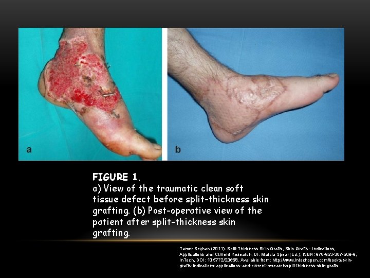 FIGURE 1. a) View of the traumatic clean soft tissue defect before split-thickness skin