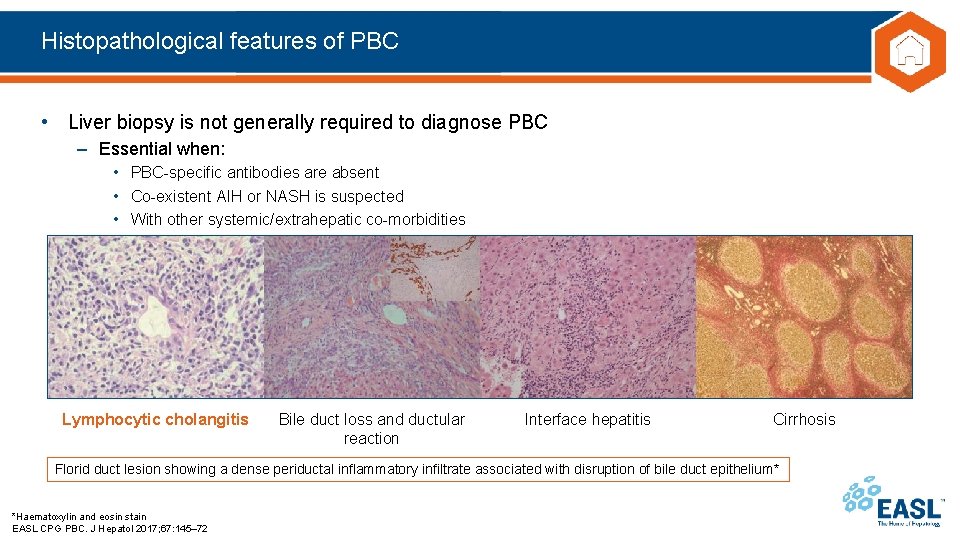 Histopathological features of PBC • Liver biopsy is not generally required to diagnose PBC