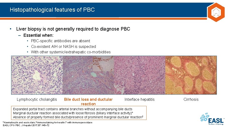 Histopathological features of PBC • Liver biopsy is not generally required to diagnose PBC