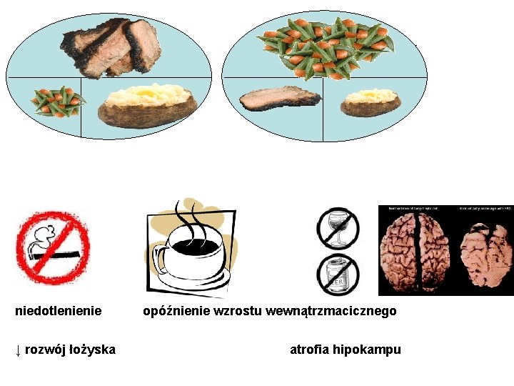 typowy posiłek niedotlenienie ↓ rozwój łożyska prawidłowy posiłek opóźnienie wzrostu wewnątrzmacicznego atrofia hipokampu 