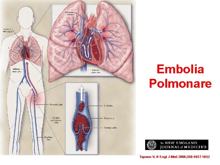 Embolia Polmonare Tapson V. N Engl J Med 2008; 358: 1037 -1052 