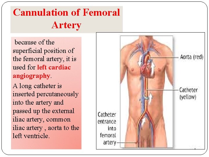 Cannulation of Femoral Artery because of the superficial position of the femoral artery, it