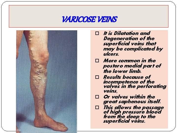 VARICOSE VEINS It is Dilatation and Degeneration of the superficial veins that may be