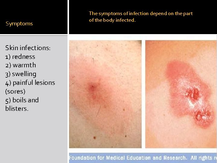 Symptoms Skin infections: 1) redness 2) warmth 3) swelling 4) painful lesions (sores) 5)