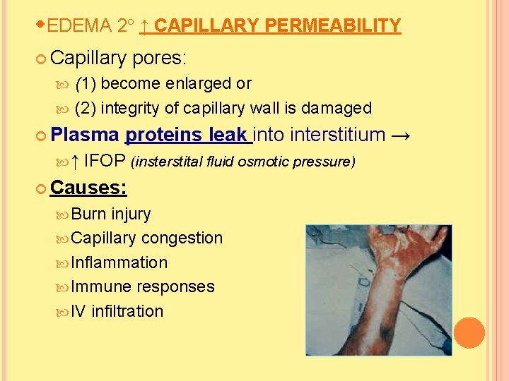 EDEMA 2 ↑ CAPILLARY PERMEABILITY Capillary pores: (1) become enlarged or (2) integrity  EDEMA 2 ↑ CAPILLARY PERMEABILITY Capillary pores: (1) become enlarged or (2) integrity