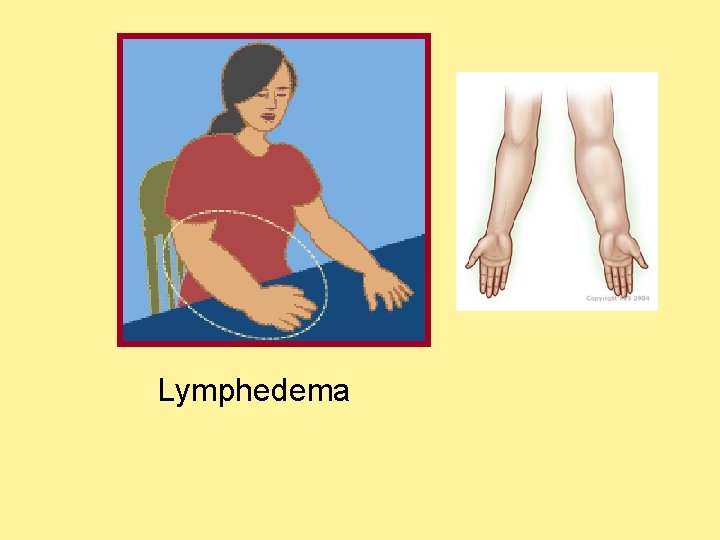 Lymphedema  Lymphedema