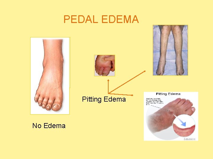 PEDAL EDEMA Pitting Edema No Edema  PEDAL EDEMA Pitting Edema No Edema