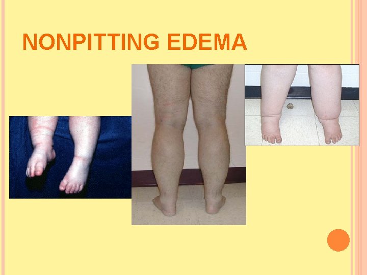 NONPITTING EDEMA  NONPITTING EDEMA