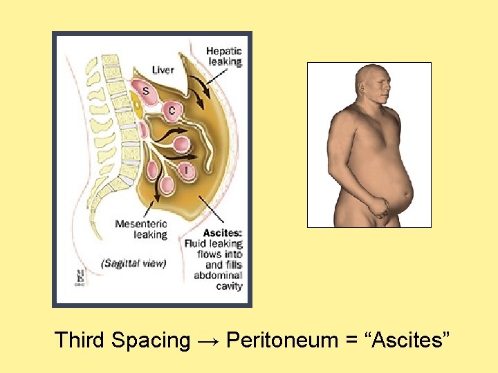 Third Spacing → Peritoneum = “Ascites”  Third Spacing → Peritoneum = “Ascites”